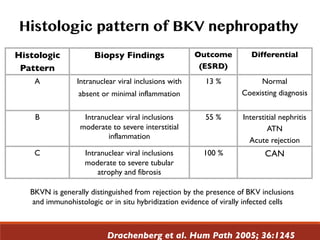 Histologic
Pattern
Biopsy Findings Outcome
(ESRD)
Differential
A Intranuclear viral inclusions with
absent or minimal inflammation
13 % Normal
Coexisting diagnosis
B Intranuclear viral inclusions
moderate to severe interstitial
inflammation
55 % Interstitial nephritis
ATN
Acute rejection
C Intranuclear viral inclusions
moderate to severe tubular
atrophy and fibrosis
100 % CAN
Histologic pattern of BKV nephropathy
Drachenberg et al. Hum Path 2005; 36:1245
BKVN is generally distinguished from rejection by the presence of BKV inclusions
and immunohistologic or in situ hybridization evidence of virally infected cells
 
