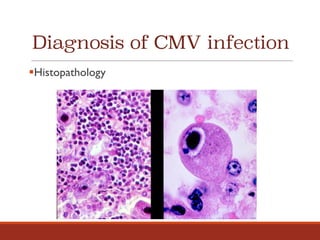 Diagnosis of CMV infection
§Histopathology
 