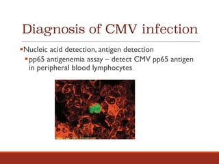 Diagnosis of CMV infection
§Nucleic acid detection, antigen detection
§pp65 antigenemia assay – detect CMV pp65 antigen
in peripheral blood lymphocytes
 