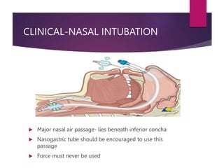 CLINICAL-NASAL INTUBATION
 Major nasal air passage- lies beneath inferior concha
 Nasogastric tube should be encouraged to use this
passage
 Force must never be used
 