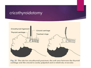 cricothyroidotomy
 