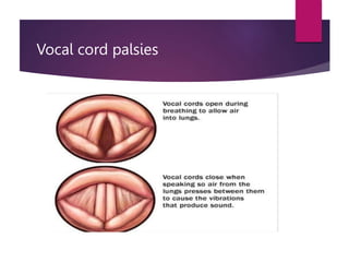 Vocal cord palsies
 