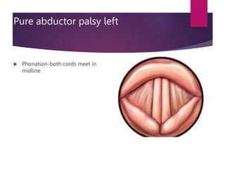 Pure abductor palsy left
 Phonation-both cords meet in
midline
 