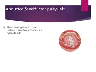 Abductor & adductor palsy-left
 Phonation-right cord crosses
midline in an attempt to meet its
opposite side
 
