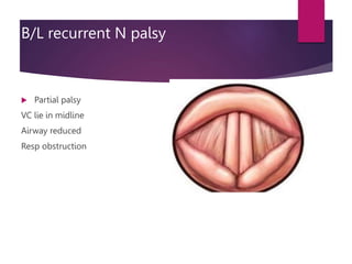 B/L recurrent N palsy
 Partial palsy
VC lie in midline
Airway reduced
Resp obstruction
 