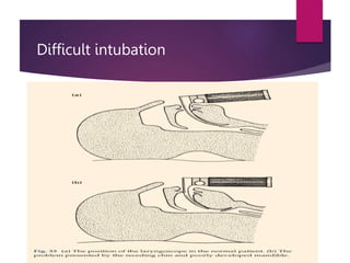 Difficult intubation
 