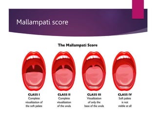 Mallampati score
 