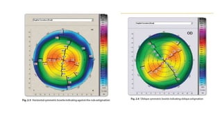 Topography and Tomography of cornea in detail | PPTX