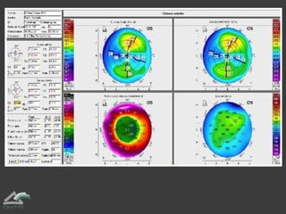 Estos aparatos también nos permiten analizar el interior del ojo de modo similar
a cuando se realiza una tomografía o “sca...