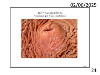 02/06/2025
21
PROTUSÃO DO CÁRDIA
Circundada por pregas longitudinais
Dyce
 