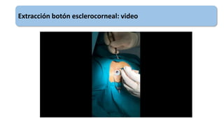 Extracción botón esclerocorneal: video
 