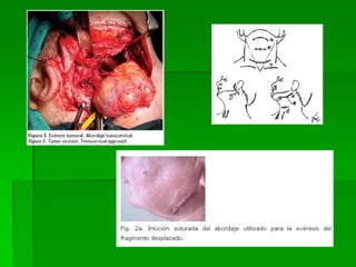 Topografica regioìn laterofaringea