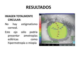 RESULTADOS
IMAGEN TOTALMENTE
  CIRCULAR:
No hay astigmatismo
  corneal.
Este ojo sólo podría
  presentar ametropías
  esféricas        como
  hipermetropía o miopía
 