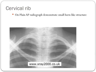 Cervical Rib On Radiograph topography of the chest - грудная клетка 2 варниант.pptx