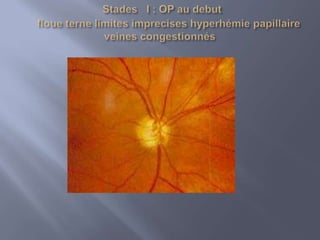  ce transport est de 2 types :A)Transport antégrade ou orthograde:Corps          axone          synapse .    Depuis le corps de la cellule ganglionnaire au niveau rétinien jusqu’au corps géniculé latéral (1ér relais synaptique ).LE PLUS IMPORTANT +++B)Transport rétrograde:Synapse         axone          corps.