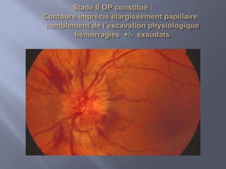 III.PHYSIOPATHOLOGIE:quelque soit L’étiologie de L’oedemepapillaire, il ya un arrêt du flux axonal .Prenons comme exemple l’OP de l’HTIC (l’étiologie la plus fréquente de l’OP  pur )