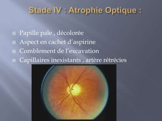 IV.DIAGNOSTIC POSITIF :A.CIRCONSTANCES DE DECOUVERTE:OPP          Aucun symptôme visuel Découvert        Examen systématique                          Bilan de céphalées  