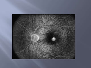  Couleur: jaune chamois plus pale que la rétine 