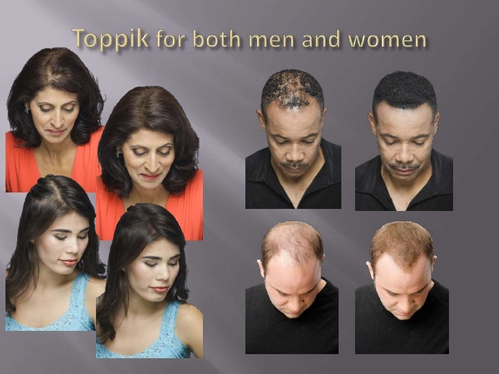 Cover up hair loss, feel more confident!