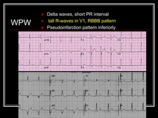 Top ten (or 11) ekg killers | PPT