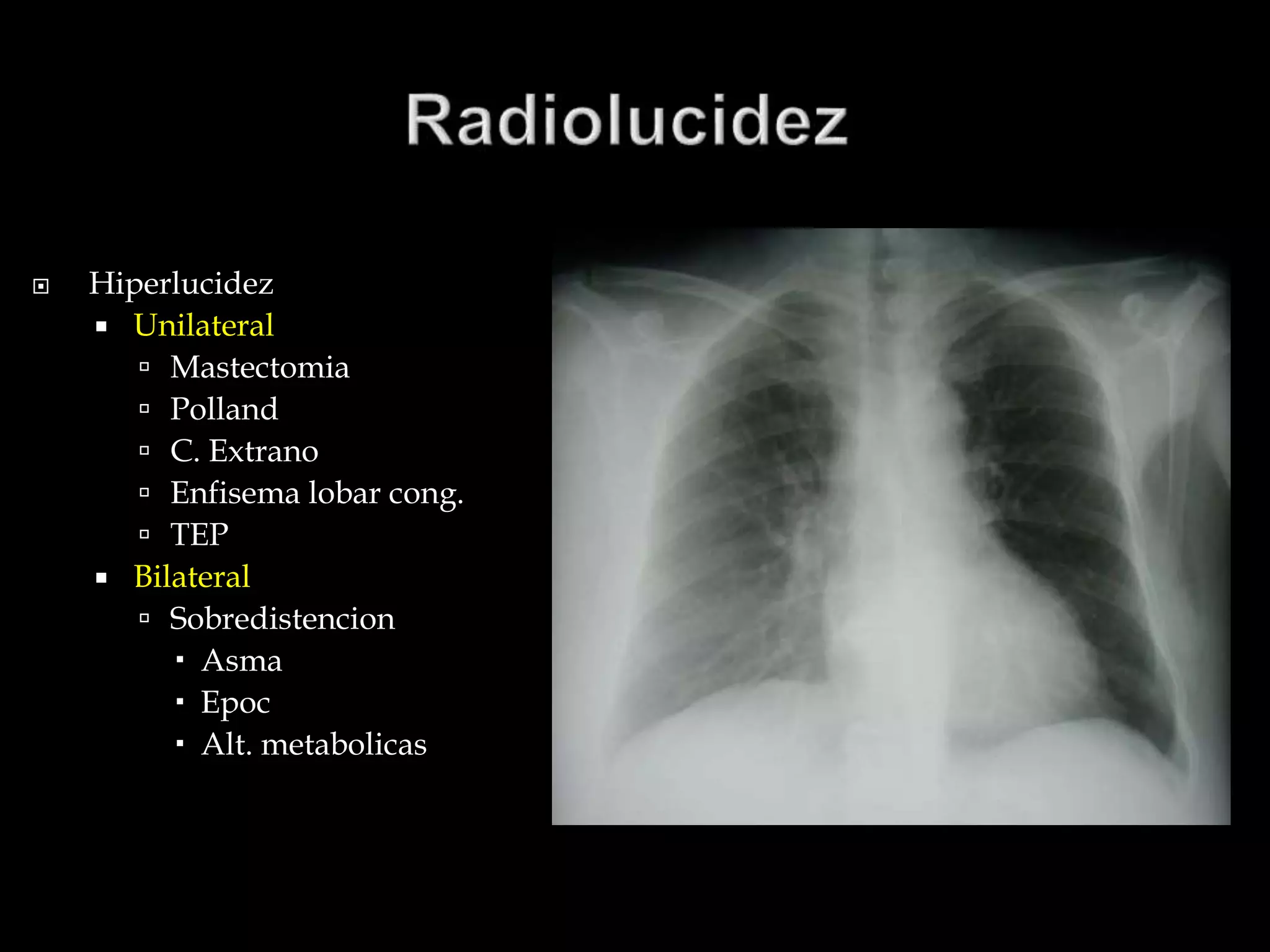  Hiperlucidez
 Unilateral
 Mastectomia
 Polland
 C. Extrano
 Enfisema lobar cong.
 TEP
 Bilateral
 Sobredistencion
 Asma
 Epoc
 Alt. metabolicas
 