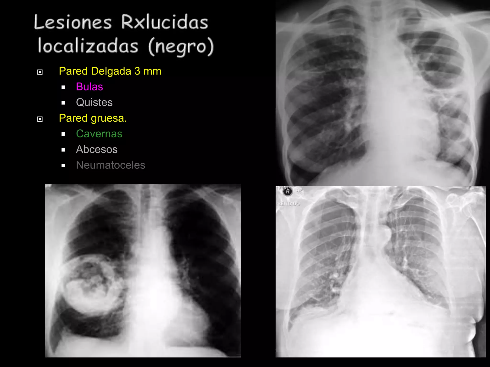  Pared Delgada 3 mm
 Bulas
 Quistes
 Pared gruesa.
 Cavernas
 Abcesos
 Neumatoceles
 