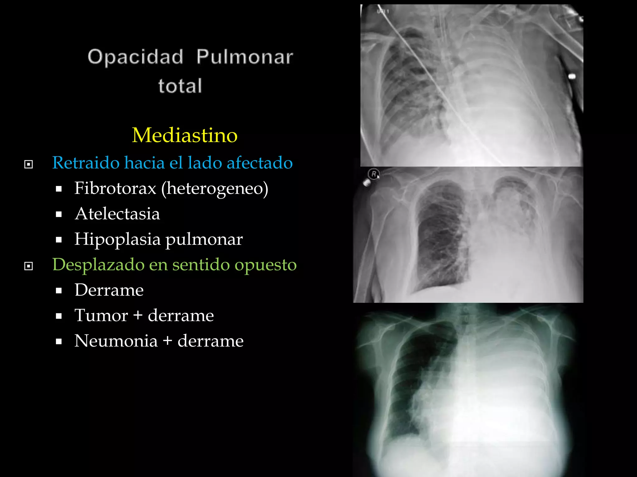 Mediastino
 Retraido hacia el lado afectado
 Fibrotorax (heterogeneo)
 Atelectasia
 Hipoplasia pulmonar
 Desplazado en sentido opuesto
 Derrame
 Tumor + derrame
 Neumonia + derrame
 