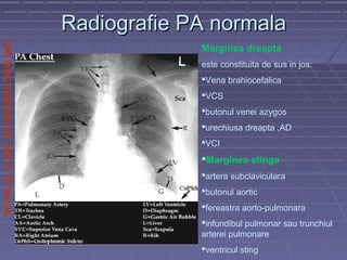 SPITALULCLINICDEPNEUMOLOGIEIASI
Radiografie PA normalaRadiografie PA normala
Marginea dreapta
este constituita de sus in jos:
Vena brahiocefalica
VCS
butonul venei azygos
urechiusa dreapta ,AD
VCI
Marginea stinga
artera subclaviculara
butonul aortic
fereastra aorto-pulmonara
infundibul pulmonar sau trunchiul
arterei pulmonare
ventricul sting
 