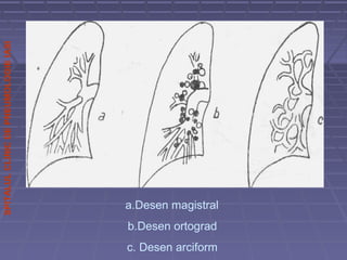 SPITALULCLINICDEPNEUMOLOGIEIASI
a.Desen magistral
b.Desen ortograd
c. Desen arciform
 