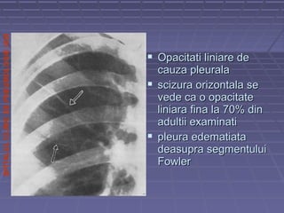 SPITALULCLINICDEPNEUMOLOGIEIASI
 Opacitati liniare deOpacitati liniare de
cauza pleuralacauza pleurala
 scizura orizontala sescizura orizontala se
vede ca o opacitatevede ca o opacitate
liniara fina la 70% dinliniara fina la 70% din
adultii examinatiadultii examinati
 pleura edematiatapleura edematiata
deasupra segmentuluideasupra segmentului
FowlerFowler
 