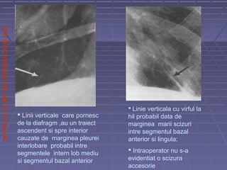 SPITALULCLINICDEPNEUMOLOGIEIASI
 Linii verticale care pornesc
de la diafragm ,au un traiect
ascendent si spre interior
cauzate de marginea pleurei
interlobare probabil intre
segmentele intern lob mediu
si segmentul bazal anterior
 Linie verticala cu virful la
hil probabil data de
marginea marii scizuri
intre segmentul bazal
anterior si lingula;
 Intraoperator nu s-a
evidentiat o scizura
accesorie
 