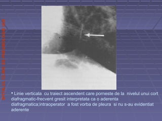 SPITALULCLINICDEPNEUMOLOGIEIASI
 Linie verticala cu traiect ascendent care porneste de la nivelul unui cort
diafragmatic-frecvent gresit interpretata ca o aderenta
diafragmatica;intraoperator a fost vorba de pleura si nu s-au evidentiat
aderente
 