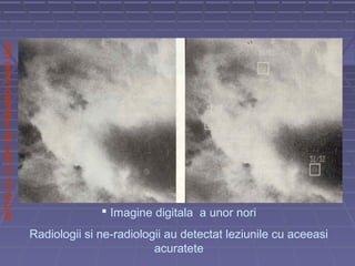 SPITALULCLINICDEPNEUMOLOGIEIASI
 Imagine digitala a unor nori
Radiologii si ne-radiologii au detectat leziunile cu aceeasi
acuratete
 
