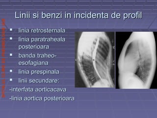 SPITALULCLINICDEPNEUMOLOGIEIASI
Linii si benzi in incidenta de profilLinii si benzi in incidenta de profil
 linia retrosternalalinia retrosternala
 linia paratrahealalinia paratraheala
posterioaraposterioara
 banda traheo-banda traheo-
esofagianaesofagiana
 linia prespinalalinia prespinala
 linii secundare:linii secundare:
-interfata aorticacava-interfata aorticacava
-linia aortica posterioara-linia aortica posterioara
 
