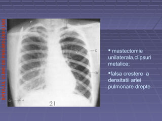 SPITALULCLINICDEPNEUMOLOGIEIASI
 mastectomie
unilaterala,clipsuri
metalice;
falsa crestere a
densitatii ariei
pulmonare drepte
 