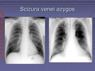 SPITALULCLINICDEPNEUMOLOGIEIASI
Scizura venei azygosScizura venei azygos
 