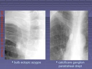 SPITALULCLINICDEPNEUMOLOGIEIASI
 bulb ectopic azygos  calcificare ganglion
paratraheal drept
 