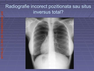 SPITALULCLINICDEPNEUMOLOGIEIASI
Radiografie incorect pozitionata sau situs
inversus total?
 
