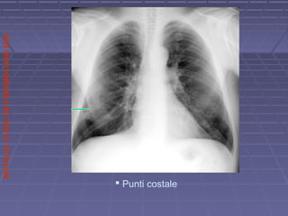 SPITALULCLINICDEPNEUMOLOGIEIASI
 Punti costale
 