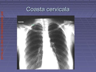 SPITALULCLINICDEPNEUMOLOGIEIASI
Coasta cervicalaCoasta cervicala
 