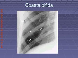 SPITALULCLINICDEPNEUMOLOGIEIASI
Coasta bifidaCoasta bifida
 