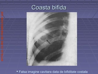 SPITALULCLINICDEPNEUMOLOGIEIASI
Coasta bifidaCoasta bifida
 Falsa imagine cavitara data de bifiditate costala
 