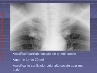 SPITALULCLINICDEPNEUMOLOGIEIASI
calcificari cartilaje costale ale primei coaste
apar in jur de 30 ani
calcificarile cartilajelor celorlalte coaste apar mai
tirziu
 
