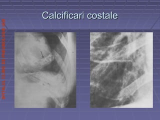 SPITALULCLINICDEPNEUMOLOGIEIASI
Calcificari costaleCalcificari costale
 
