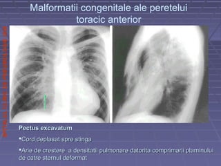 SPITALULCLINICDEPNEUMOLOGIEIASI
Pectus excavatumPectus excavatum
Cord deplasat spre stingaCord deplasat spre stinga
Arie de crestere a densitatii pulmonare datorita comprimarii plaminuluiArie de crestere a densitatii pulmonare datorita comprimarii plaminului
de catre sternul deformatde catre sternul deformat
Malformatii congenitale ale peretelui
toracic anterior
 