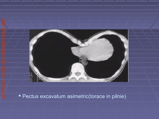 SPITALULCLINICDEPNEUMOLOGIEIASI
 Pectus excavatum asimetric(torace in pilnie)
 