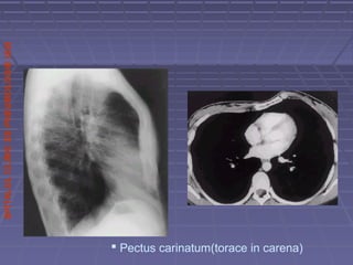 SPITALULCLINICDEPNEUMOLOGIEIASI
 Pectus carinatum(torace in carena)
 