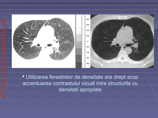 SPITALULCLINICDEPNEUMOLOGIEIASI
 Utilizarea ferestrelor de densitate are drept scop
accentuarea contrastului vizual intre structurile cu
densitati apropiate
 