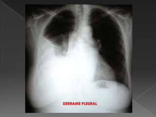 DERRAME PLEURAL
 