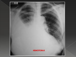 HEMOTORAX
 
